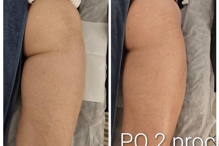 SkinLift RF by Ieva, galerijos nuotrauka 2