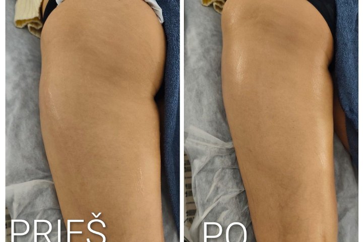 SkinLift RF by Ieva, galerijos nuotrauka 3